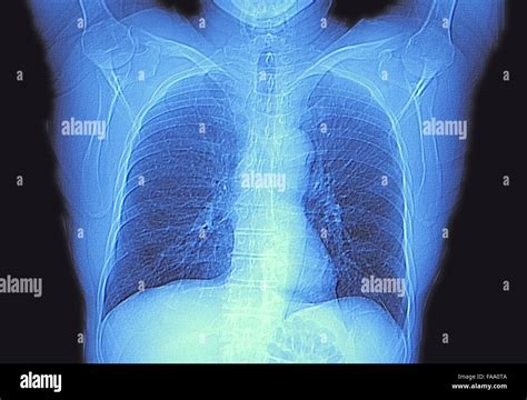 Heart & Lung Scan .